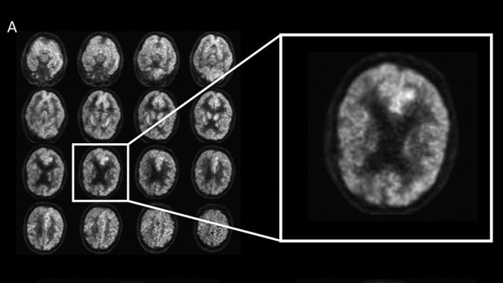 Medicina experimental reduce efectos del alzheimer